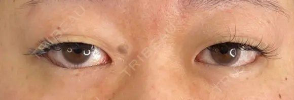 二重埋没 / 眼瞼下垂（切開） / 上まぶたの脂肪取り 藤・ナチュレ美容クリニック 銀座院 BEFORE メイン用