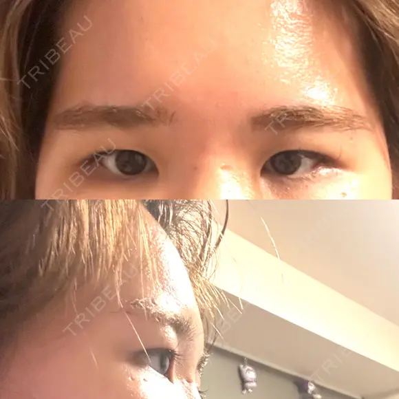 二重埋没 / 目頭切開 / 目尻切開 / 上まぶたの脂肪取り / タレ目形成・グラマラスライン（切開） / 目尻靭帯移動 / 自然癒着法 / 眼瞼下垂（非切開） / ヒアルロン酸注入（唇） / ボトックス（人中） / ヒアルロン酸注入（鼻翼基部） BITO BEAUTY CLINIC BEFORE メイン用