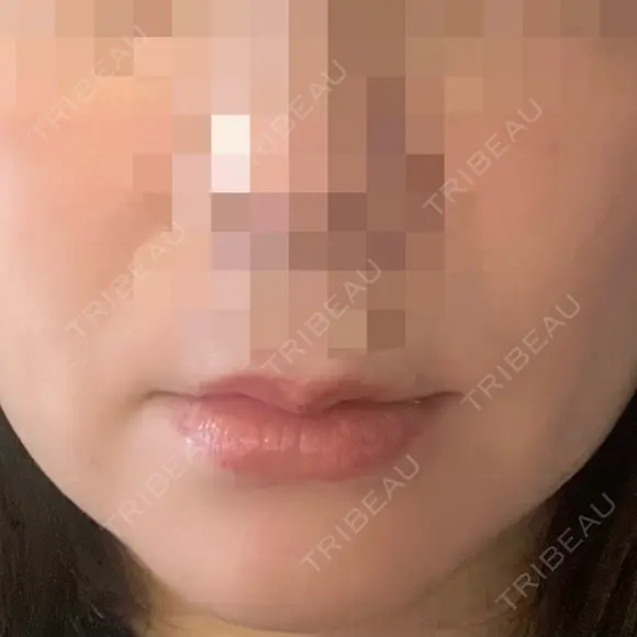 糸リフト 福岡TAクリニック BEFORE メイン用
