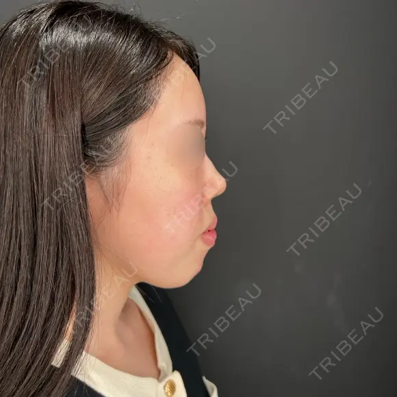 ボトックス（あご） / ヒアルロン酸注入（あご） / ボトックス（眉間） / ヒアルロン酸注入（鼻翼基部） HAAB×DREAM BEAUTY CLINIC 大阪梅田院 BEFORE メイン用