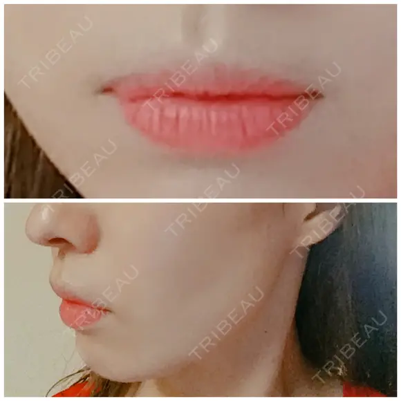ガミースマイル手術 / ヒアルロン酸注入（唇） / ボトックス（口角） エートップ美容整形外科 BEFORE メイン用