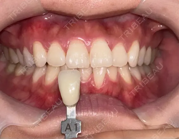 矯正（マウスピース） 湘南歯科クリニック 池袋院 BEFORE メイン用