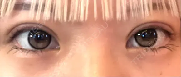 ヒアルロン酸注入（涙袋） / ヒアルロン酸注入（唇） / ボトックス（口角） AI Beauty Clinic （エーアイ美容クリニック） BEFORE メイン用