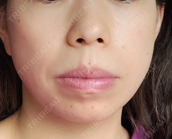 ポテンツァ TCB東京中央美容外科 宇都宮院 BEFORE メイン用