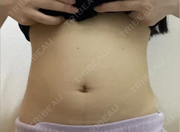 脂肪溶解注射（お腹） ミケイ医院 BEFORE メイン用