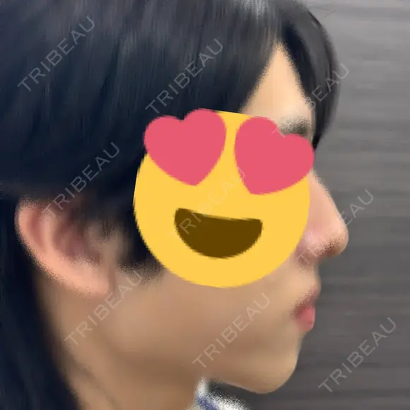 ヒアルロン酸注入（あご） TCB東京中央美容外科 新潟院 BEFORE メイン用
