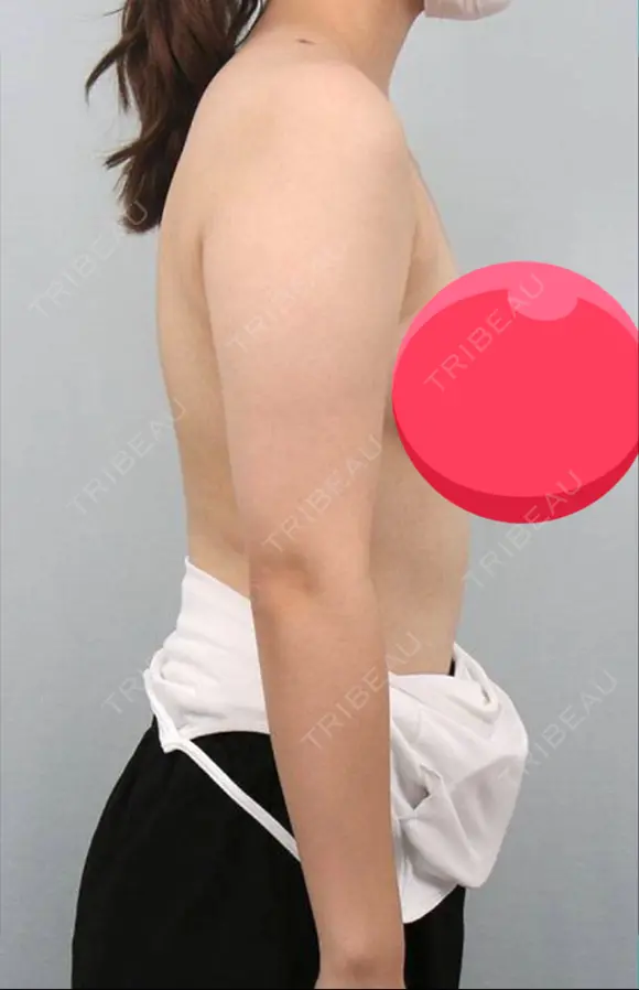 脂肪吸引（二の腕） プチパーティー医院 BEFORE メイン用