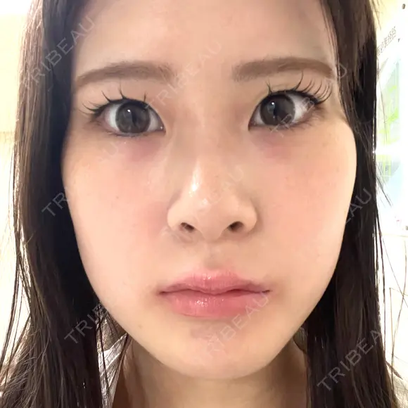 ヒアルロン酸注入（涙袋） 共立美容外科 梅田院 BEFORE メイン用