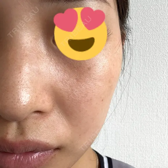 ピーリング（ハリ・ツヤ） / ルメッカ PureMe Skin Clinic（ピュアミースキンクリニック麻布） BEFORE メイン用