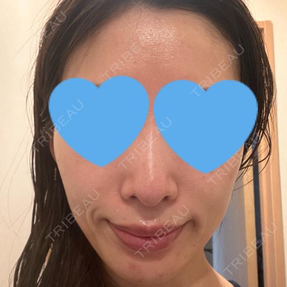 光治療（フォトフェイシャルなど） RainBoW Clinic TOKYO BEFORE メイン用