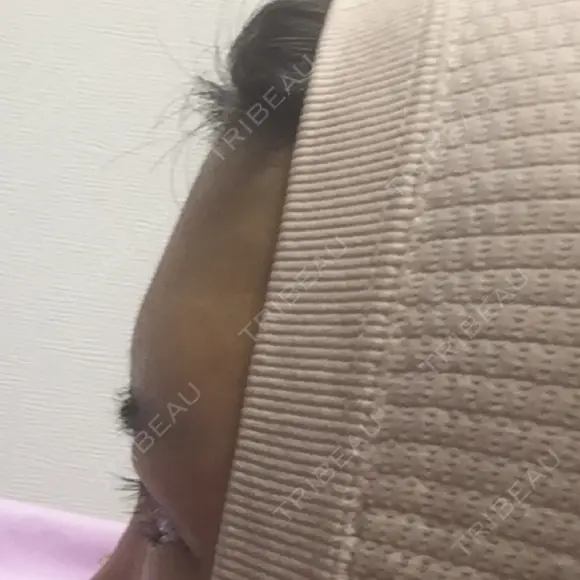 額を丸く エートップ美容整形外科 BEFORE メイン用