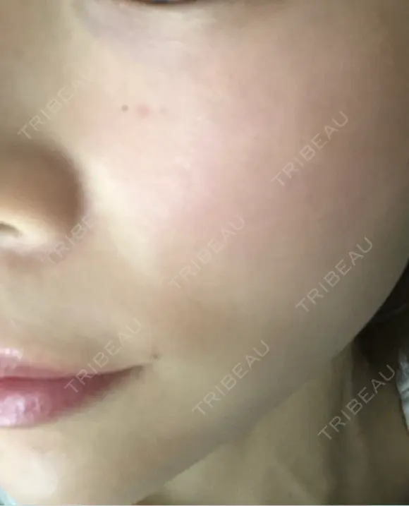 毛穴洗浄（ハイドラフェイシャルなど） / ルメッカ ON-CLINIC Beauty BEFORE メイン用