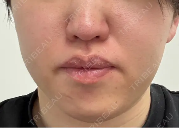 医療脱毛（顔） 東京シルククリニック 東京神田院 BEFORE メイン用