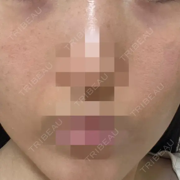 ニードルRF（ポテンツァなど） ながしま形成外科クリニック BEFORE メイン用