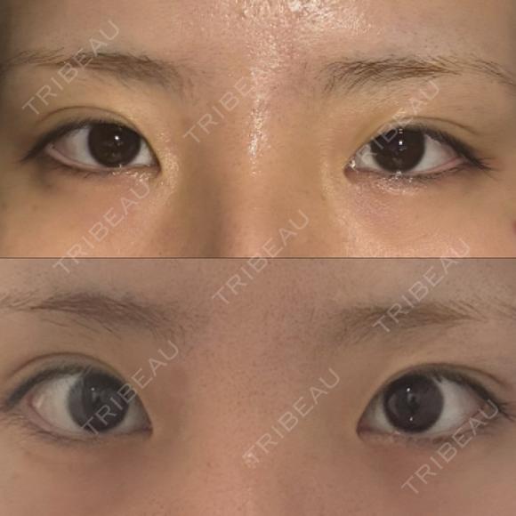 目頭切開 / タレ目形成・グラマラスライン（埋没） ネビュラクリニック 東京錦糸町院 BEFORE メイン用