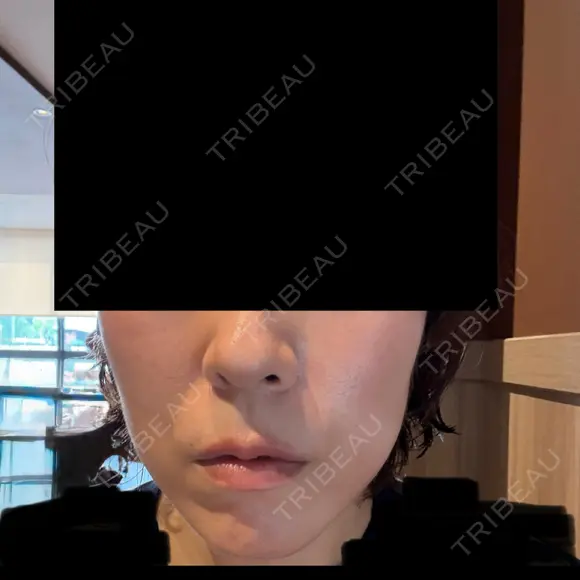 ハイフ（顔） / 毛穴洗浄（ハイドラフェイシャルなど） S-Laboクリニック 渋谷院 BEFORE メイン用