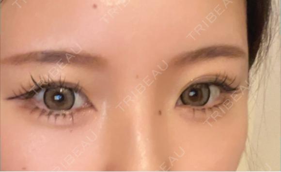 二重切開 MIL CLINIC OSAKA BEFORE メイン用