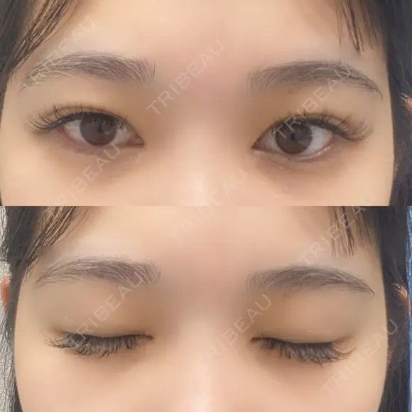 二重埋没 / RF（高周波）たるみ治療 Wing clinic 豊中駅前院 BEFORE メイン用