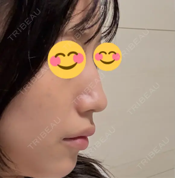 鼻尖形成（切開） / ワシ鼻修正・ハンプ切除 / 眉間プロテーゼ / 鼻柱下降・鼻唇角形成（猫手術） / ヒアルロン酸注入（額） グローバルビューティークリニック 大阪院 BEFORE メイン用