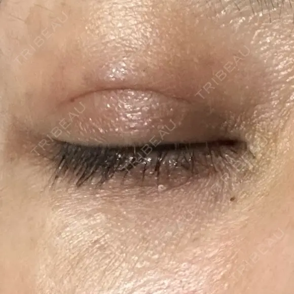 その他（目元） TCB東京中央美容外科 梅田茶屋町院 BEFORE メイン用