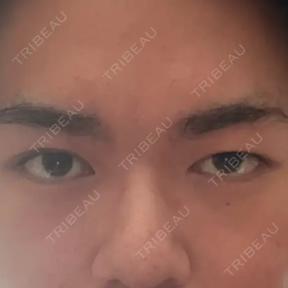 眼瞼下垂（切開） / 上まぶたの脂肪取り 新前橋かしま眼科形成外科クリニック BEFORE メイン用