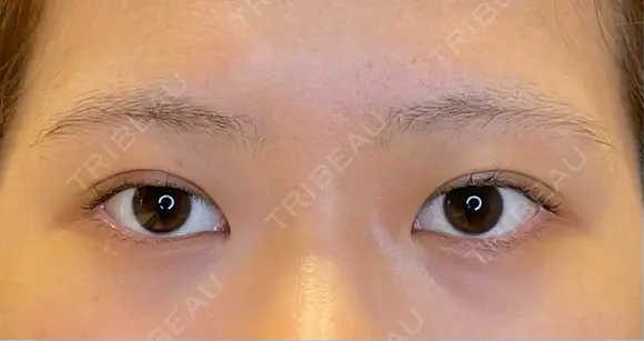 目尻切開 / タレ目形成・グラマラスライン（埋没） LOUIS CLINIC 二子玉川院【ルイクリニック】 BEFORE メイン用