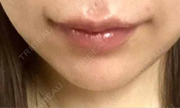 ヒアルロン酸注入（唇） / ボトックス（口角） BITO BEAUTY CLINIC BEFORE メイン用