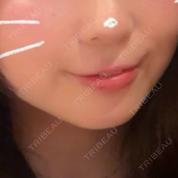 ヒアルロン酸注入（唇） / ボトックス（口角） / RF（高周波）たるみ治療 ルラ美容クリニック 京都院 BEFORE メイン用