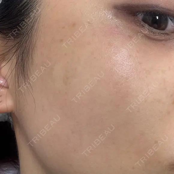 ピコスポット ビューティー和心クリニック 浅草院 BEFORE メイン用