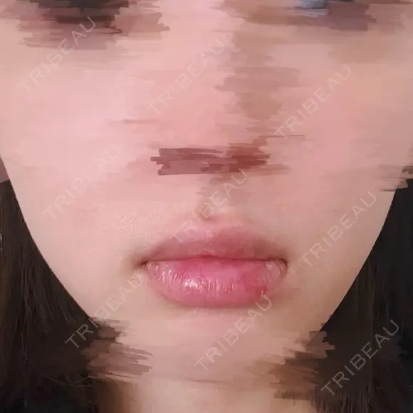 口唇縮小術 Kono Clinic BEFORE メイン用