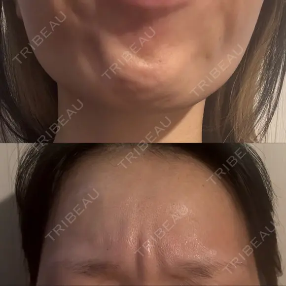 ボトックス（あご） / ボトックス（眉間） / ボトックス（額） TCB東京中央美容外科 名古屋栄院 BEFORE メイン用