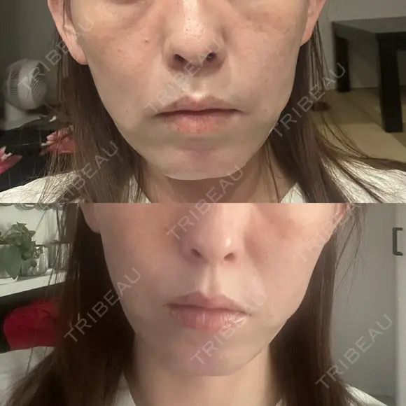 肌ヒアルロン酸注入（たるみ・シワ改善） / ショッピングリフト 大阪TAクリニック BEFORE メイン用