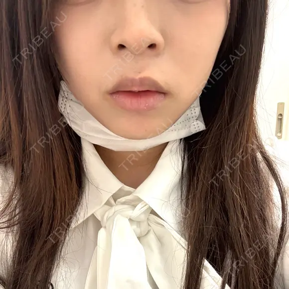 ヒアルロン酸注入（唇） / ボトックス（口角） ルラ美容クリニック 大阪本院 BEFORE メイン用