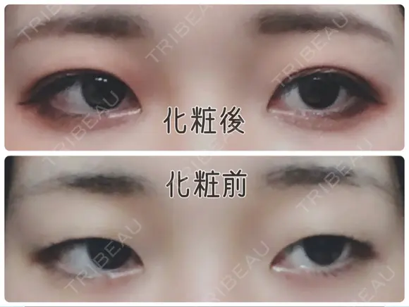 二重埋没 城本クリニック 姫路院 BEFORE メイン用