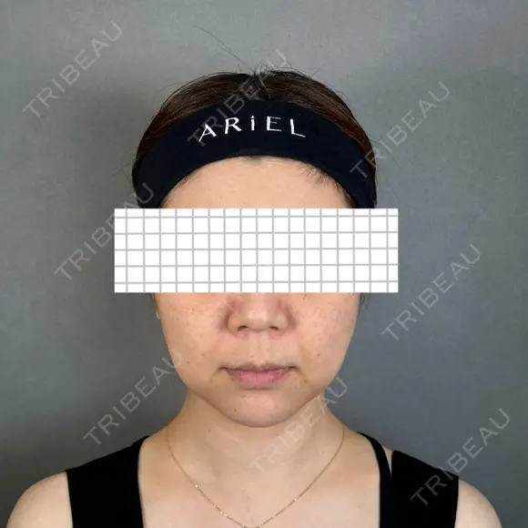 バッカルファット除去 アリエル美容クリニック 大宮院 BEFORE メイン用