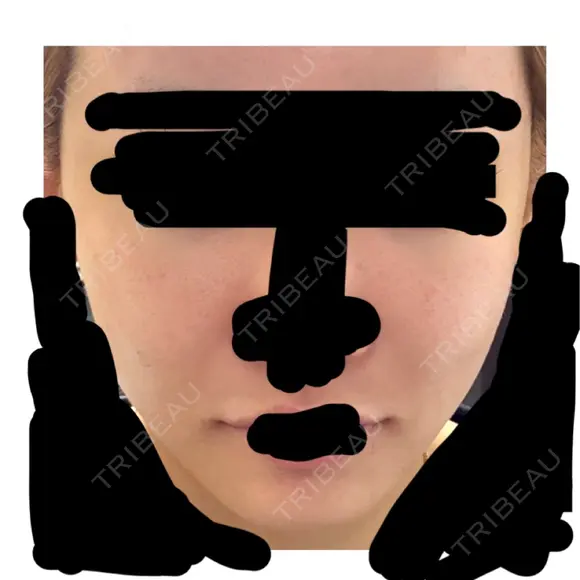 糸リフト / ボトックス（あご） / ボトックス（口角） / ボトックス（タレ目） / ボトックス（肩） / ボトックス（目尻） 東京シルククリニック 新宿院 BEFORE メイン用