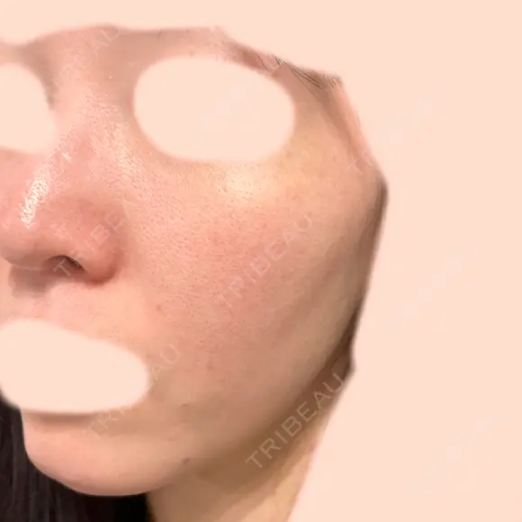 ピーリング（ハリ・ツヤ） 大美会クリニック 梅田院 BEFORE メイン用