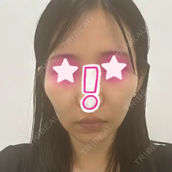 ヒアルロン酸注入（あご） / ヒアルロン酸注入（頬） / ヒアルロン酸注入（こめかみ） / ヒアルロン酸注入（鼻翼基部） DMTC CLINIC 日本橋院 BEFORE メイン用