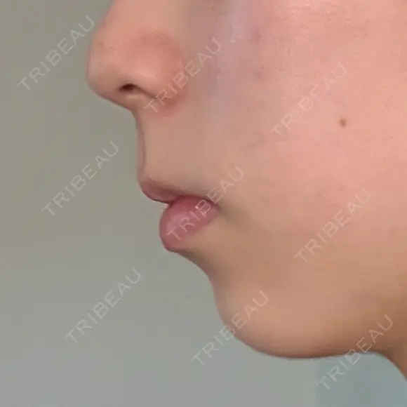 ヒアルロン酸注入（あご） KIMI CLINIC 形成・美容外科 BEFORE メイン用