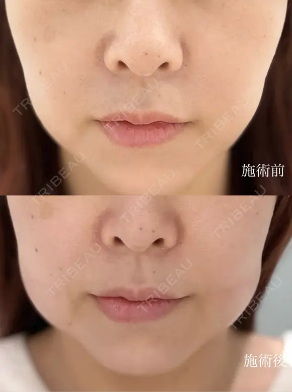 脂肪溶解注射（顔） / ボトックス（口角） / ボトックス（眉間） / ボトックス（額） / その他（肌） ルラ美容クリニック 仙台院 / ルラスキンクリニック 仙台院 BEFORE メイン用