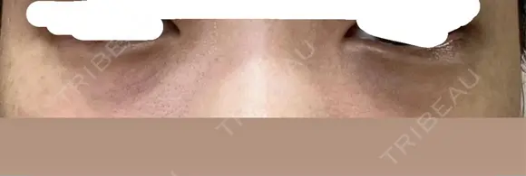 クマ治療 Kinshicho Beauty Clinic （錦糸町ビューティークリニック） BEFORE メイン用