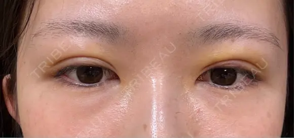 クマ治療 / 下まぶたたるみ取り / 下まぶたの脂肪取り APOLLO BEAUTY CLINIC BEFORE メイン用