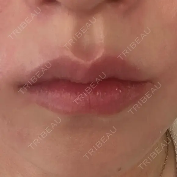 ヒアルロン酸注入（唇） AZ BEAUTY CLINIC BEFORE メイン用