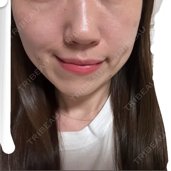 RF（高周波）たるみ治療 ルラ美容クリニック 福岡本院 BEFORE メイン用