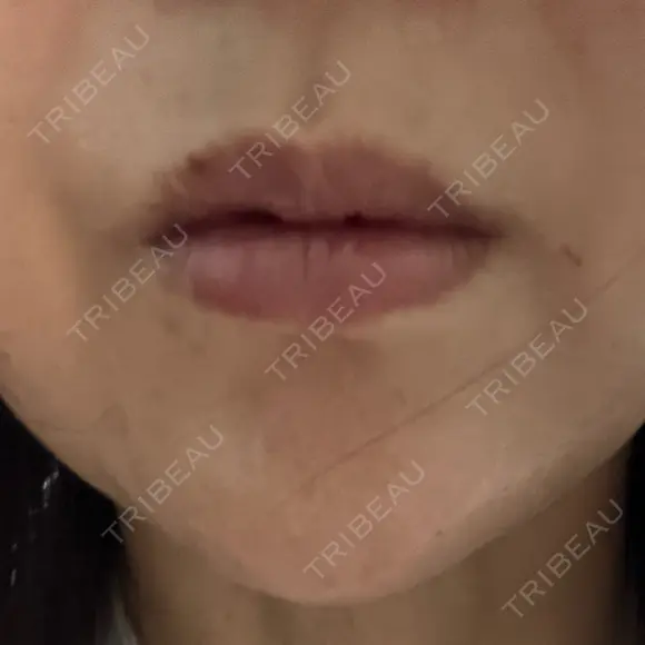 肌ヒアルロン酸注入（たるみ・シワ改善） / ピコレーザートーニング（美白・肝斑） 渋谷美容外科クリニック 横浜院 BEFORE メイン用