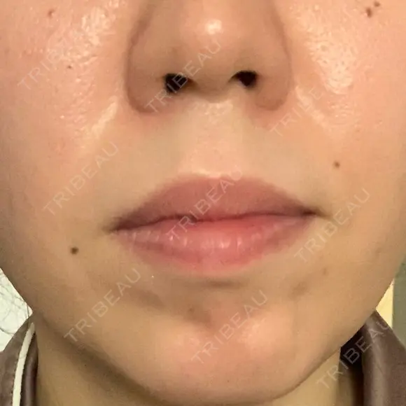 ボトックス（あご） / ボトックス（目尻） / ボトックス（額） 代々木駅前美容クリニック BEFORE メイン用