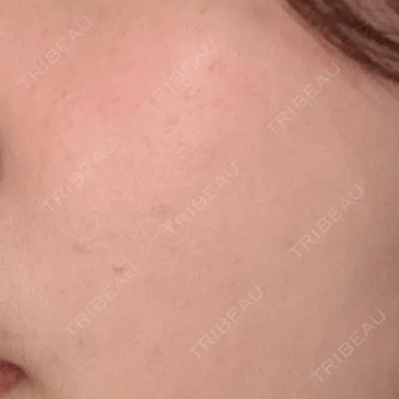 ルメッカ ON-CLINIC Beauty BEFORE メイン用