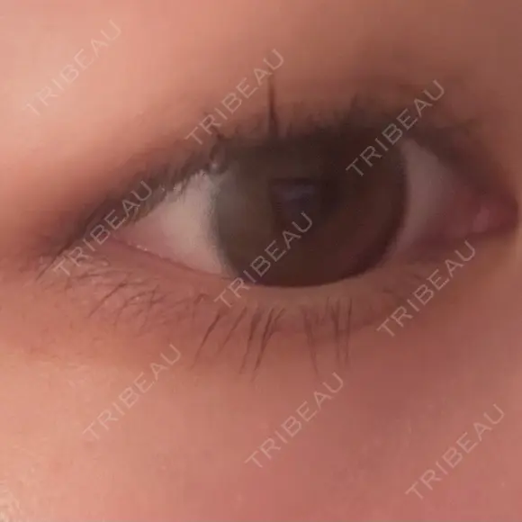 ヒアルロン酸注入（涙袋） TCB東京中央美容外科 長野院 BEFORE メイン用