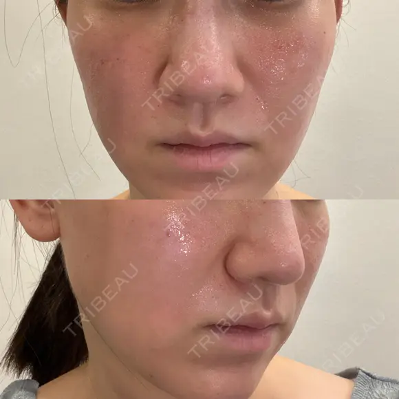 毛穴洗浄（ハイドラフェイシャルなど） / ポテンツァ ルラ美容クリニック 京都院 BEFORE メイン用