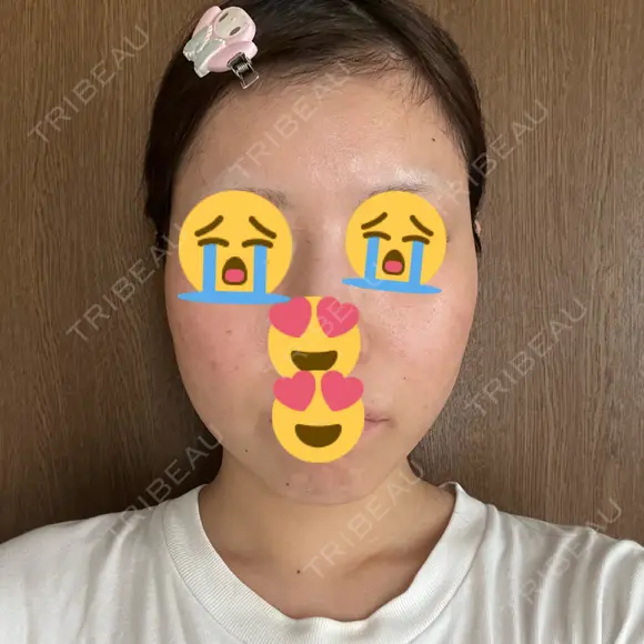 糸リフト / 脂肪吸引（顔） / ヒアルロン酸注入（あご） Wing clinic 豊中駅前院 BEFORE メイン用